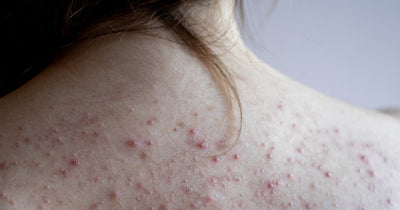 Fungal Acne - What is it and how do I treat it?