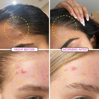 Hydrocolloid Blemish Clearing Patches - Clear Skin Days